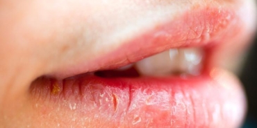 agiz-ve-dudaktaki-yaralari-hafife-almayin-onemli-hastaliklarin-belirtisi-olabilir-edyzMTvw.jpg